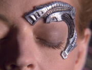 Sevens Okularimplantat