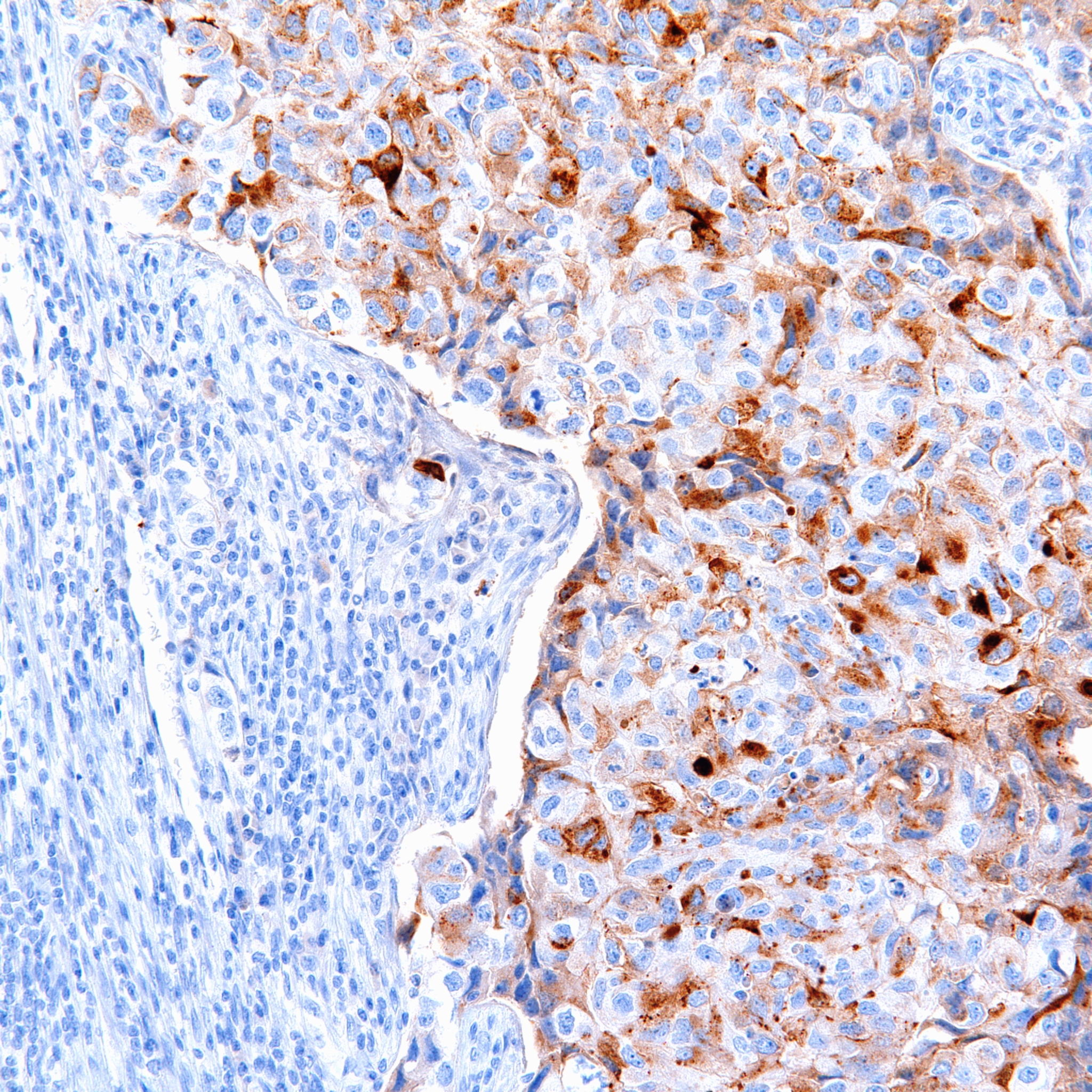 image-brst2-high-grade-ductal-carcinoma-maybe-200x-jpg-pathology