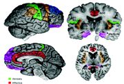 Schematic of cortical areas involved with pain processing and fMRI cropped